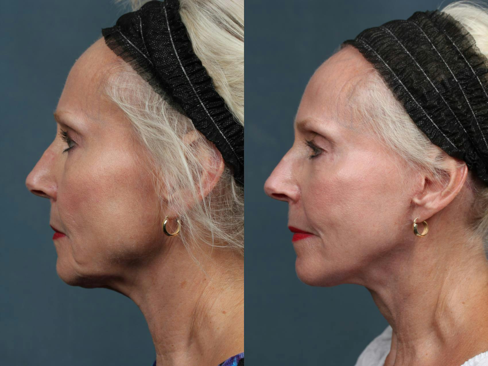 Facelift Before & After Gallery - Patient 362224 - Image 3