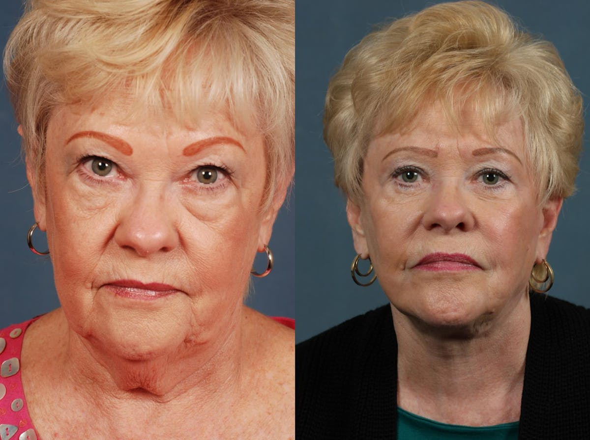 Facelift Before & After Gallery - Patient 361614 - Image 1