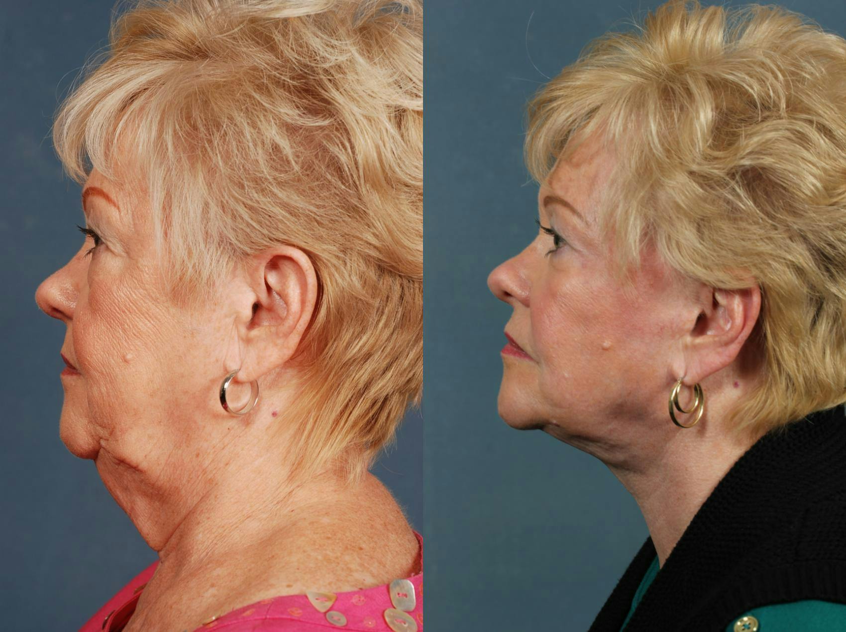 Facelift Before & After Gallery - Patient 361614 - Image 2