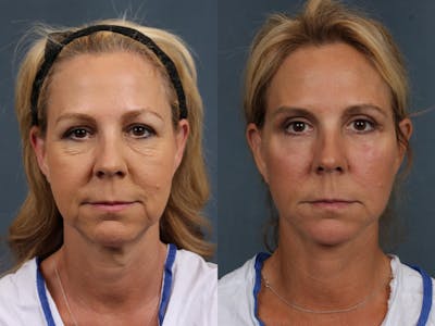 Facelift Before & After Gallery - Patient 103443 - Image 1