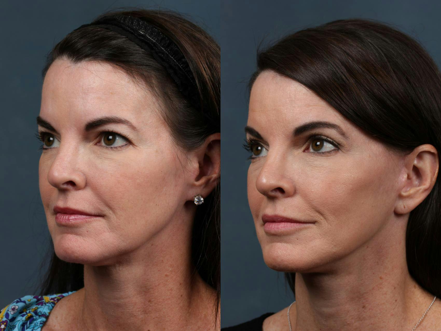 Facelift Before & After Gallery - Patient 363231 - Image 3