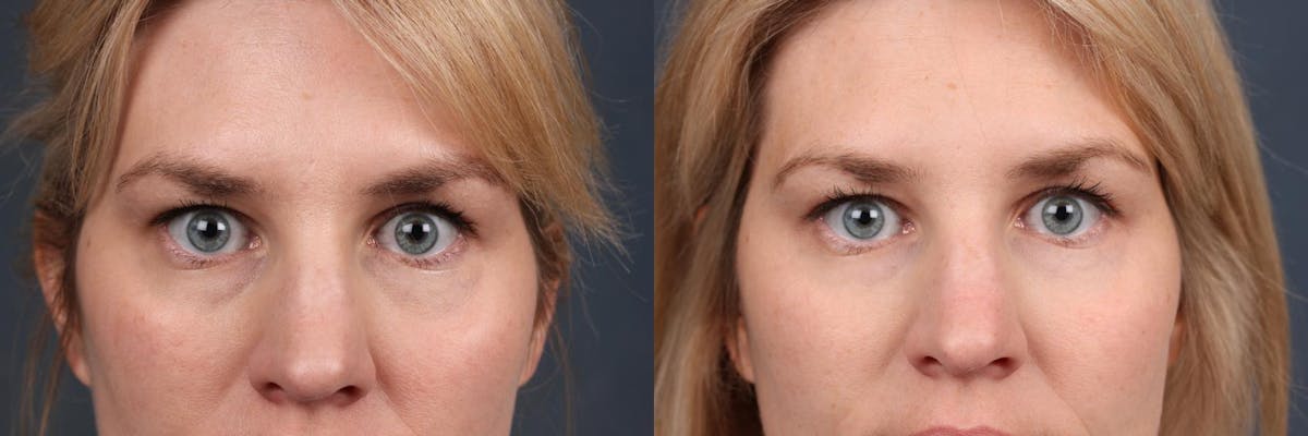 Fat Transfer Before & After Gallery - Patient 301619 - Image 1