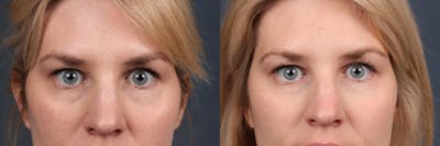 Fat Transfer Before & After Gallery - Patient 301619 - Image 1