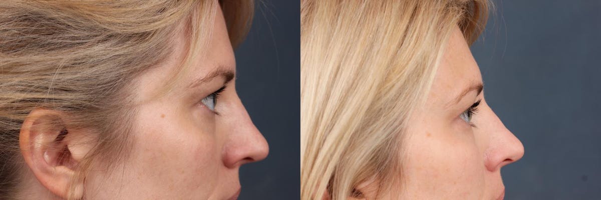 Fat Transfer Before & After Gallery - Patient 301619 - Image 3