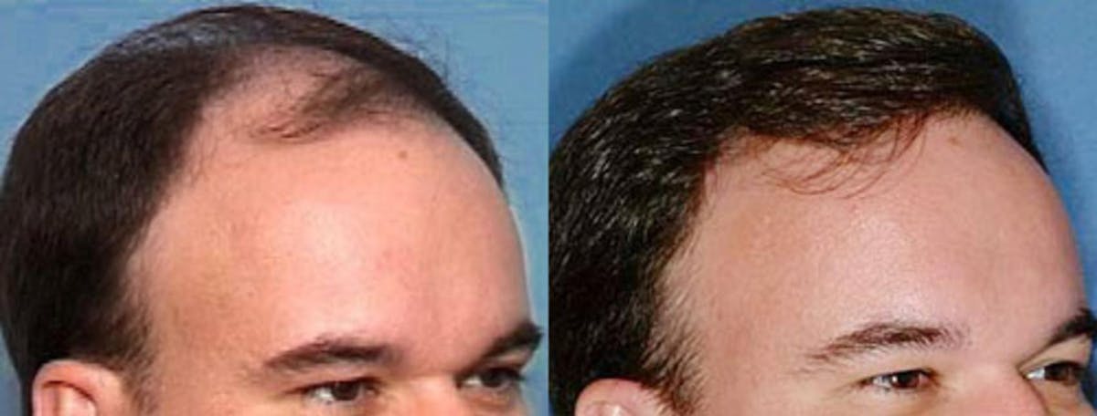 Hair Transplant Before & After Gallery - Patient 165372 - Image 2