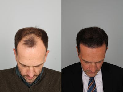 NeoGraft Hair Transplant Before & After Gallery - Patient 175318 - Image 1
