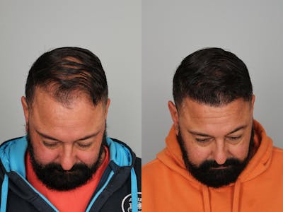 Hair Transplant Before & After Gallery - Patient 280984 - Image 1