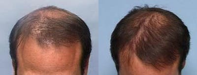 Hair Transplant Before & After Gallery - Patient 290161 - Image 1