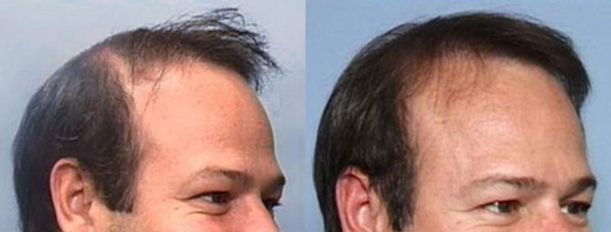Hair Transplant Before & After Gallery - Patient 290161 - Image 2