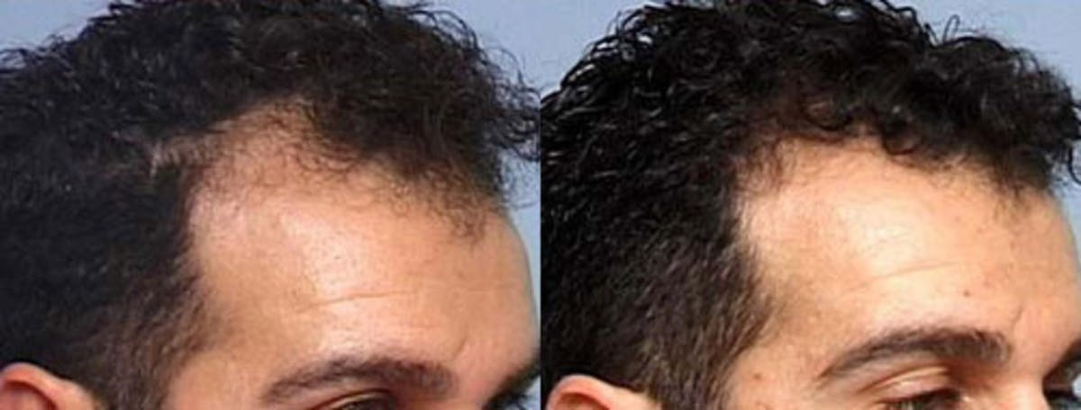 Hair Transplant Before & After Gallery - Patient 379604 - Image 2