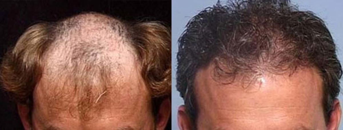 Hair Transplant Before & After Gallery - Patient 233017 - Image 1