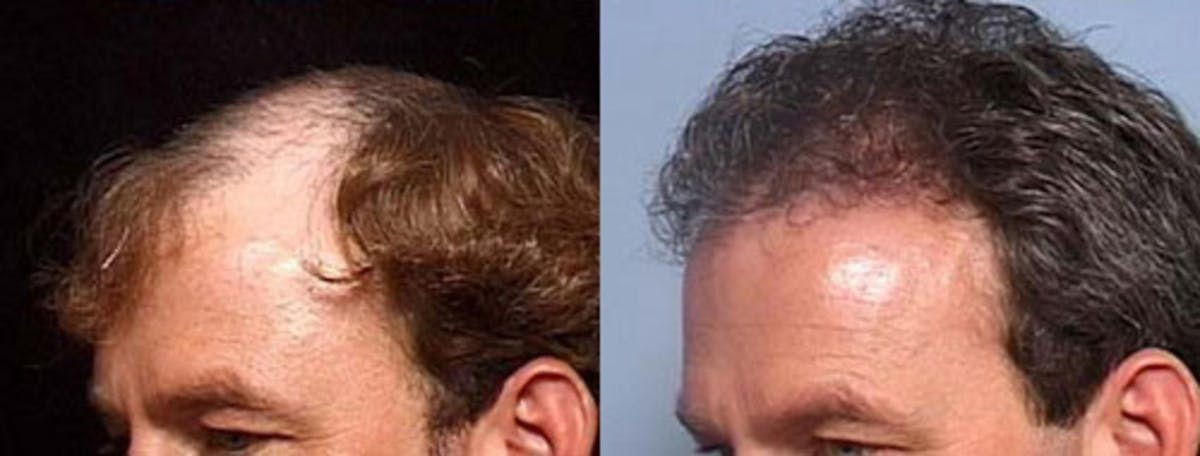 Hair Transplant Before & After Gallery - Patient 233017 - Image 2