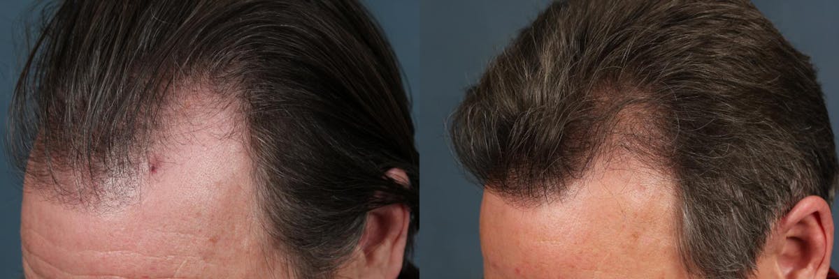 Hair Transplant Before & After Gallery - Patient 178957 - Image 1