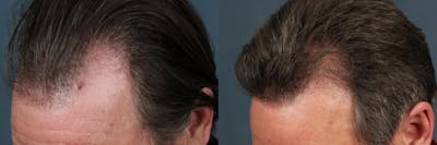Hair Transplant Before & After Gallery - Patient 178957 - Image 1