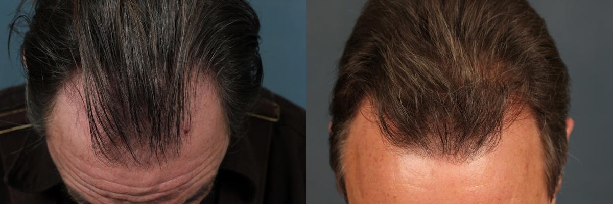 Hair Transplant Before & After Gallery - Patient 178957 - Image 2