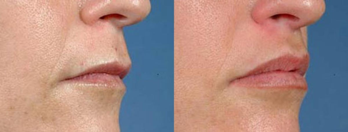 Lip Lift Before & After Gallery - Patient 391784 - Image 1
