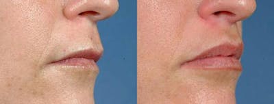 Lip Lift Before & After Gallery - Patient 391784 - Image 1