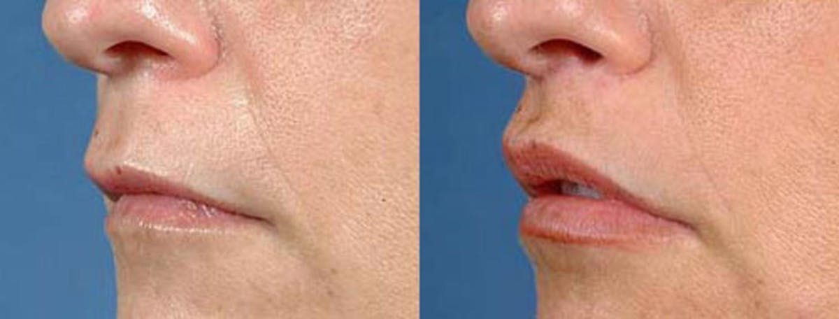 Lip Lift Before & After Gallery - Patient 391784 - Image 2