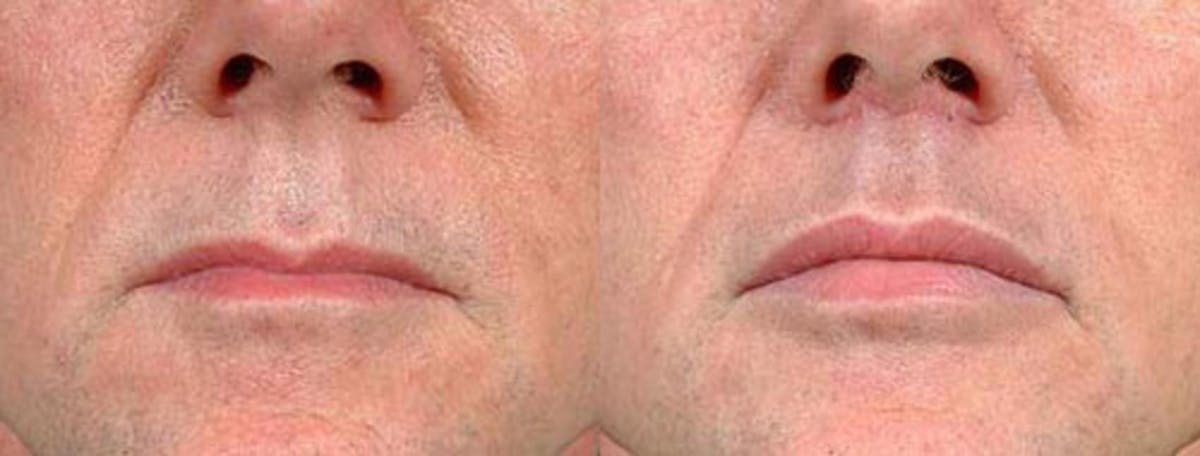 Lip Lift Before & After Gallery - Patient 224120 - Image 1