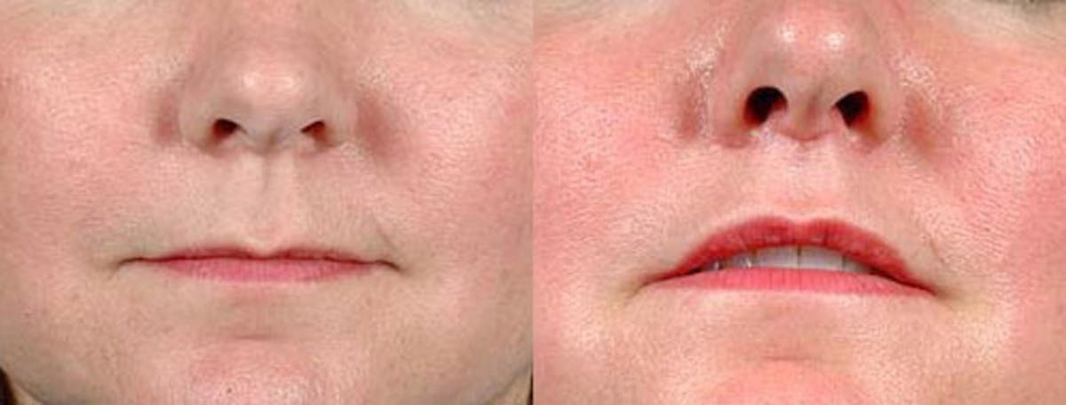 Lip Lift Before & After Gallery - Patient 406048 - Image 1
