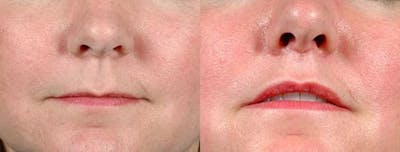 Lip Lift Before & After Gallery - Patient 406048 - Image 1