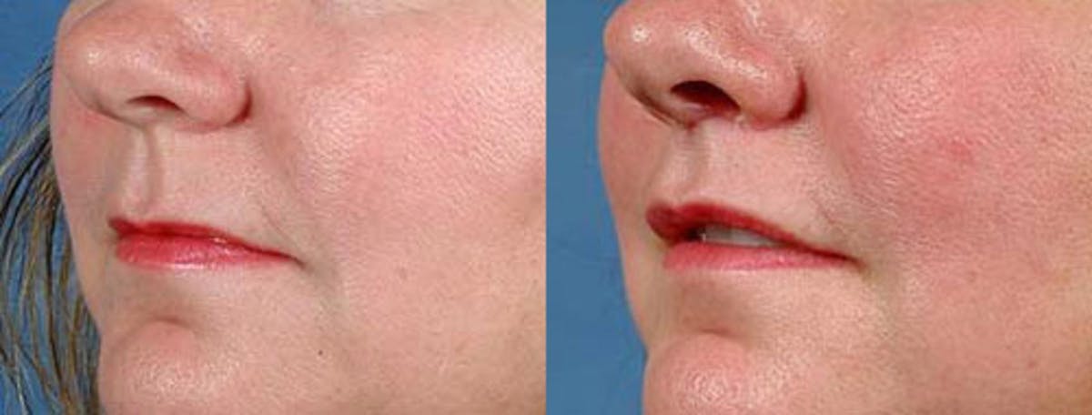 Lip Lift Before & After Gallery - Patient 406048 - Image 2