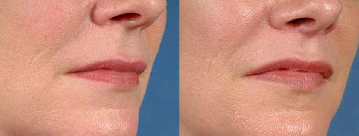 Lip Lift Before & After Gallery - Patient 100747 - Image 2