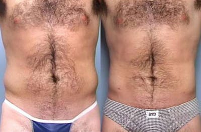 Liposuction for Men Before & After Gallery - Patient 149244 - Image 1