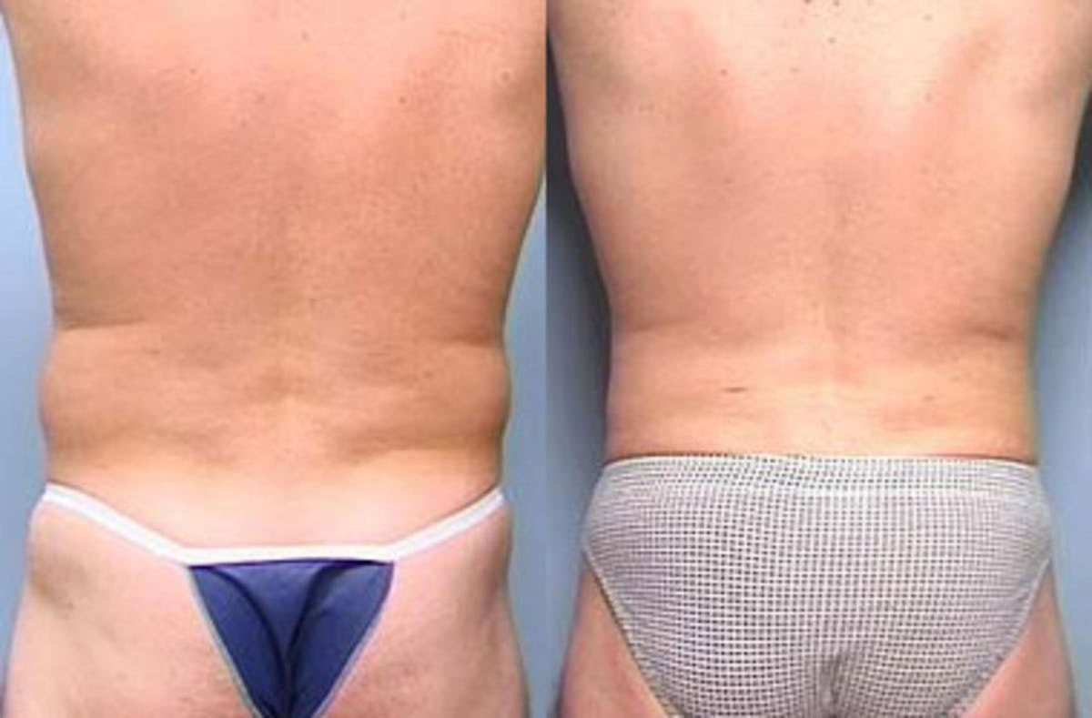 Liposuction for Men Before & After Gallery - Patient 149244 - Image 2
