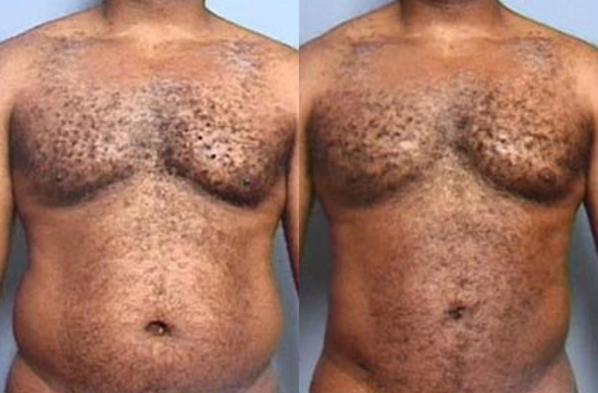 Liposuction for Men Before & After Gallery - Patient 322123 - Image 1