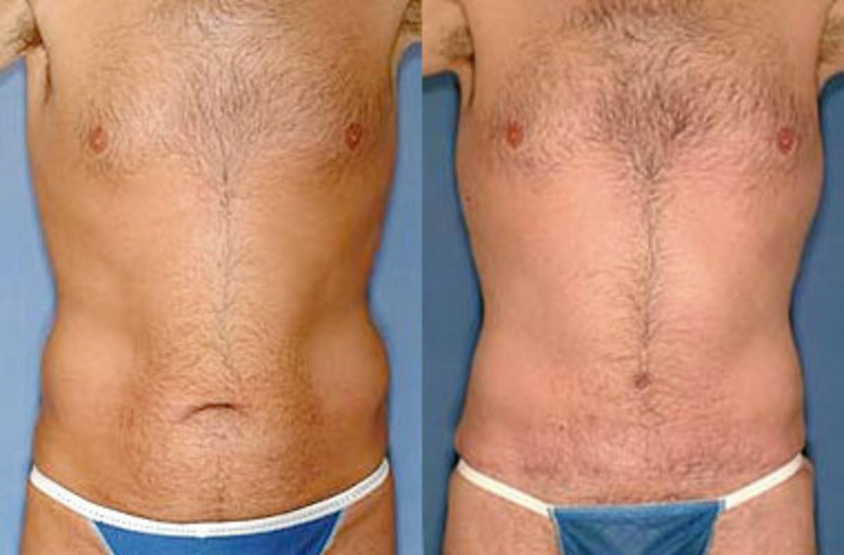 Liposuction for Men Before & After Gallery - Patient 386158 - Image 1