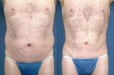 Liposuction for Men Before & After Gallery - Patient 119776 - Image 1