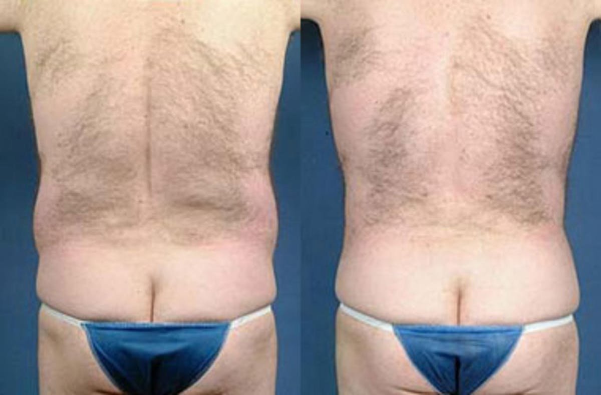 Liposuction for Men Before & After Gallery - Patient 119776 - Image 2