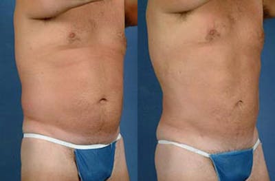 Liposuction for Men Before & After Gallery - Patient 377198 - Image 1