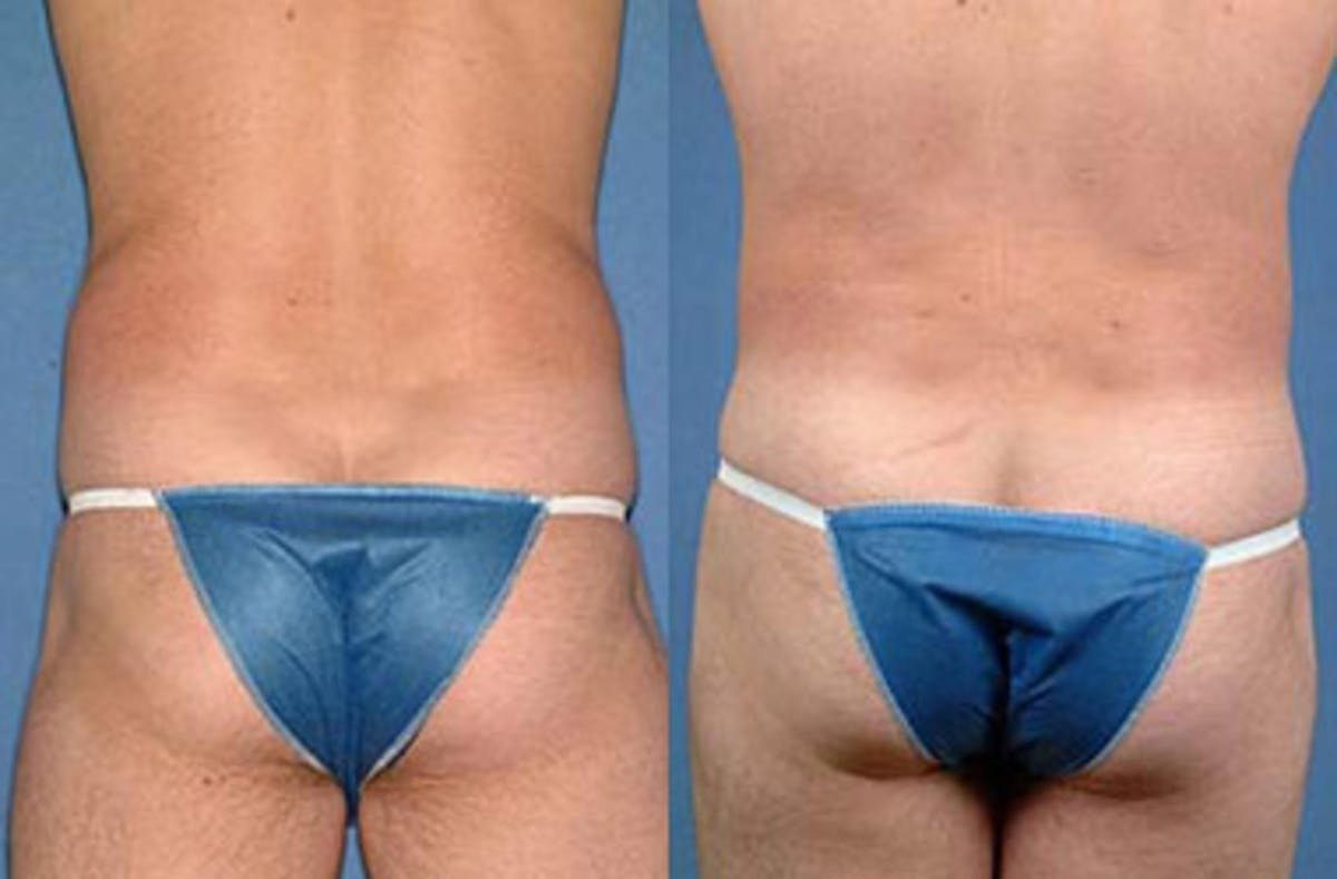 Liposuction for Men Before & After Gallery - Patient 125837 - Image 2