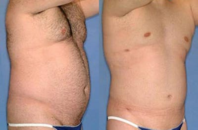 Liposuction for Men Before & After Gallery - Patient 187535 - Image 1