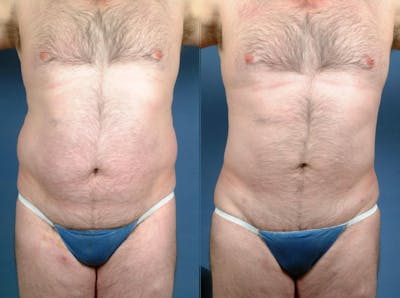 Liposuction for Men Before & After Gallery - Patient 756161 - Image 1