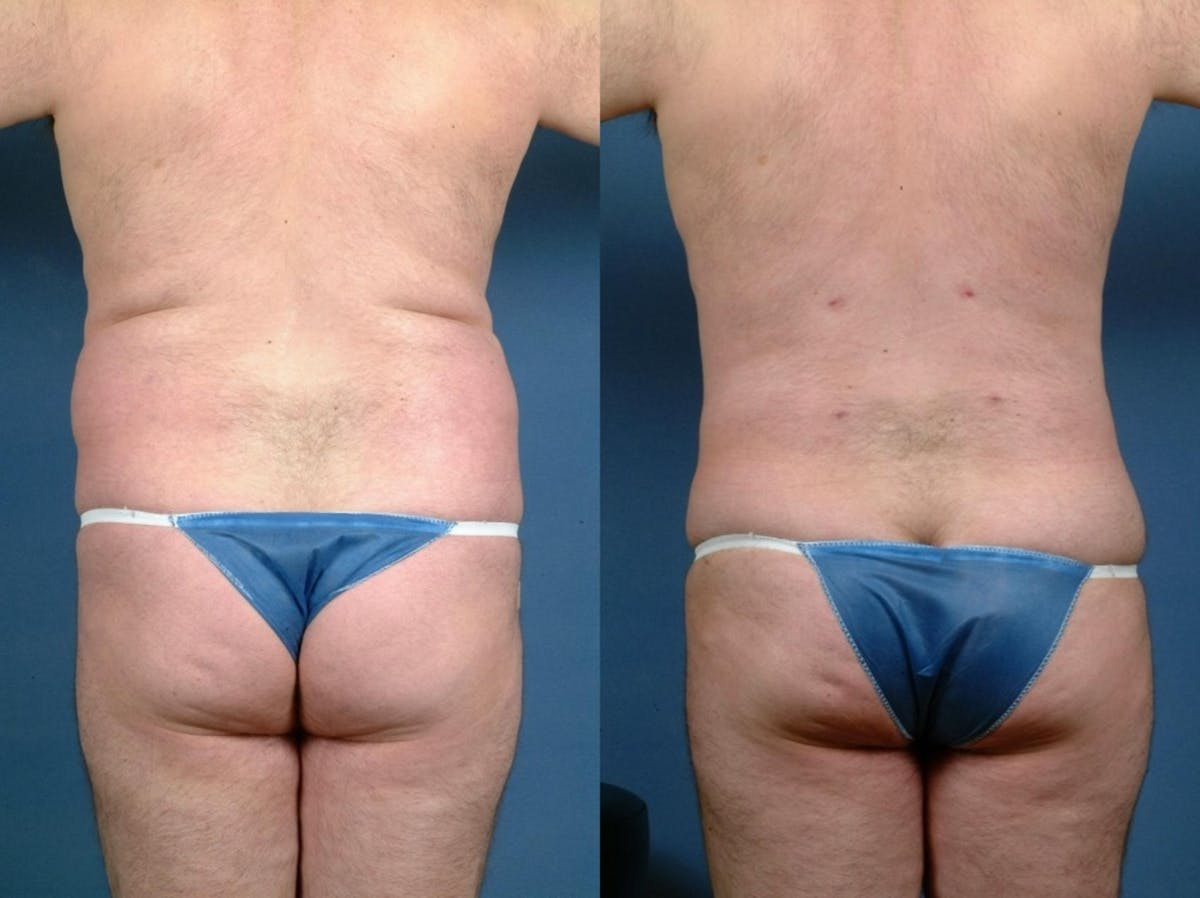 Liposuction for Men Before & After Gallery - Patient 756161 - Image 2