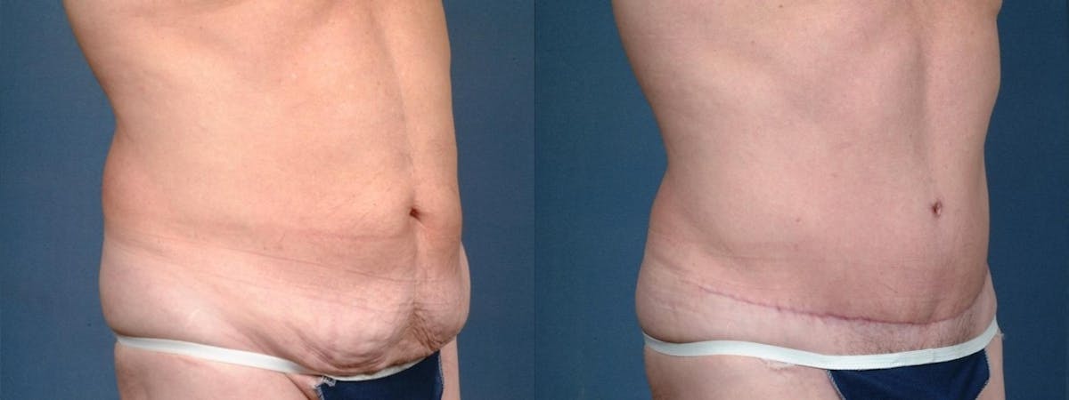 Tummy Tuck Before & After Gallery - Patient 122583 - Image 2