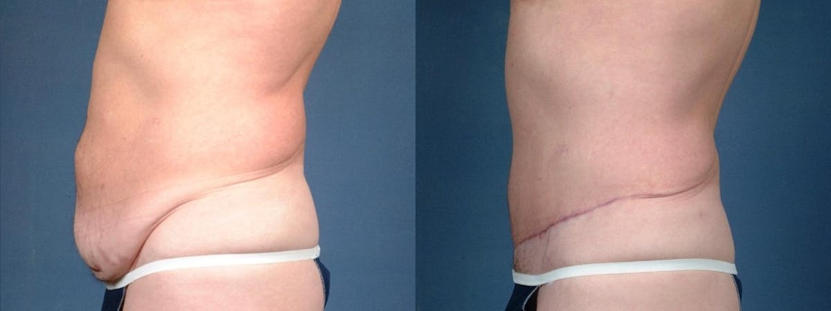 Tummy Tuck Before & After Gallery - Patient 122583 - Image 3