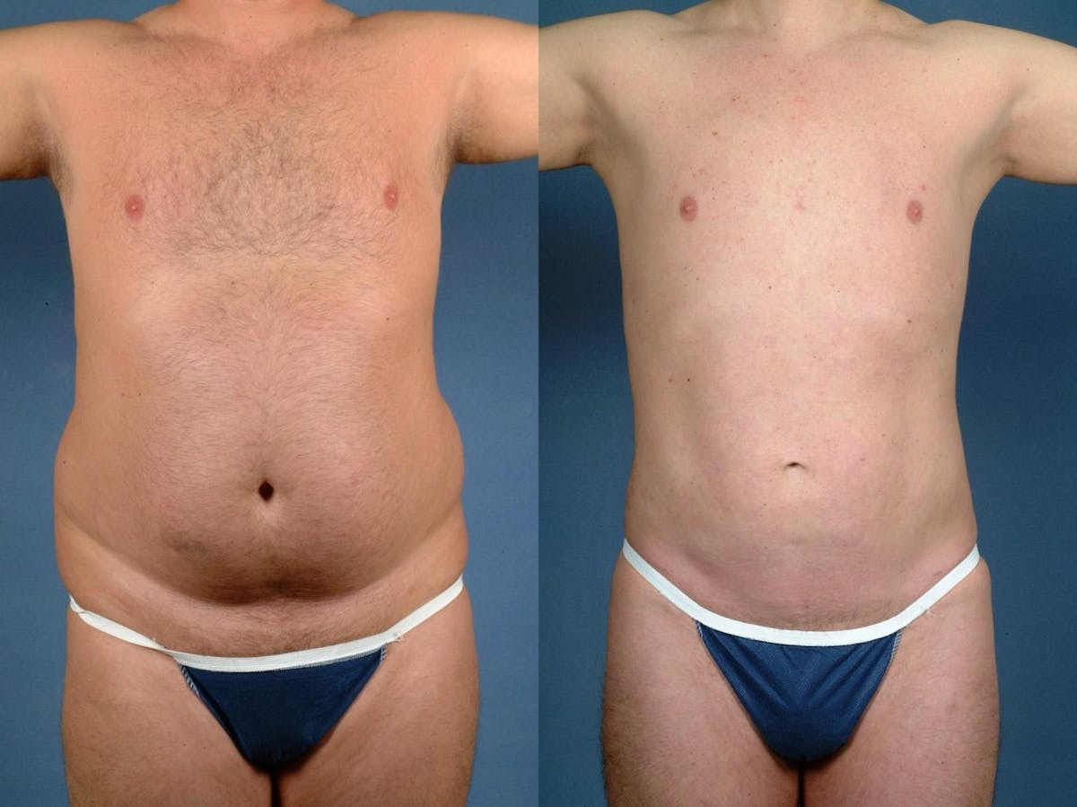 Liposuction for Men Before & After Gallery - Patient 733792 - Image 1