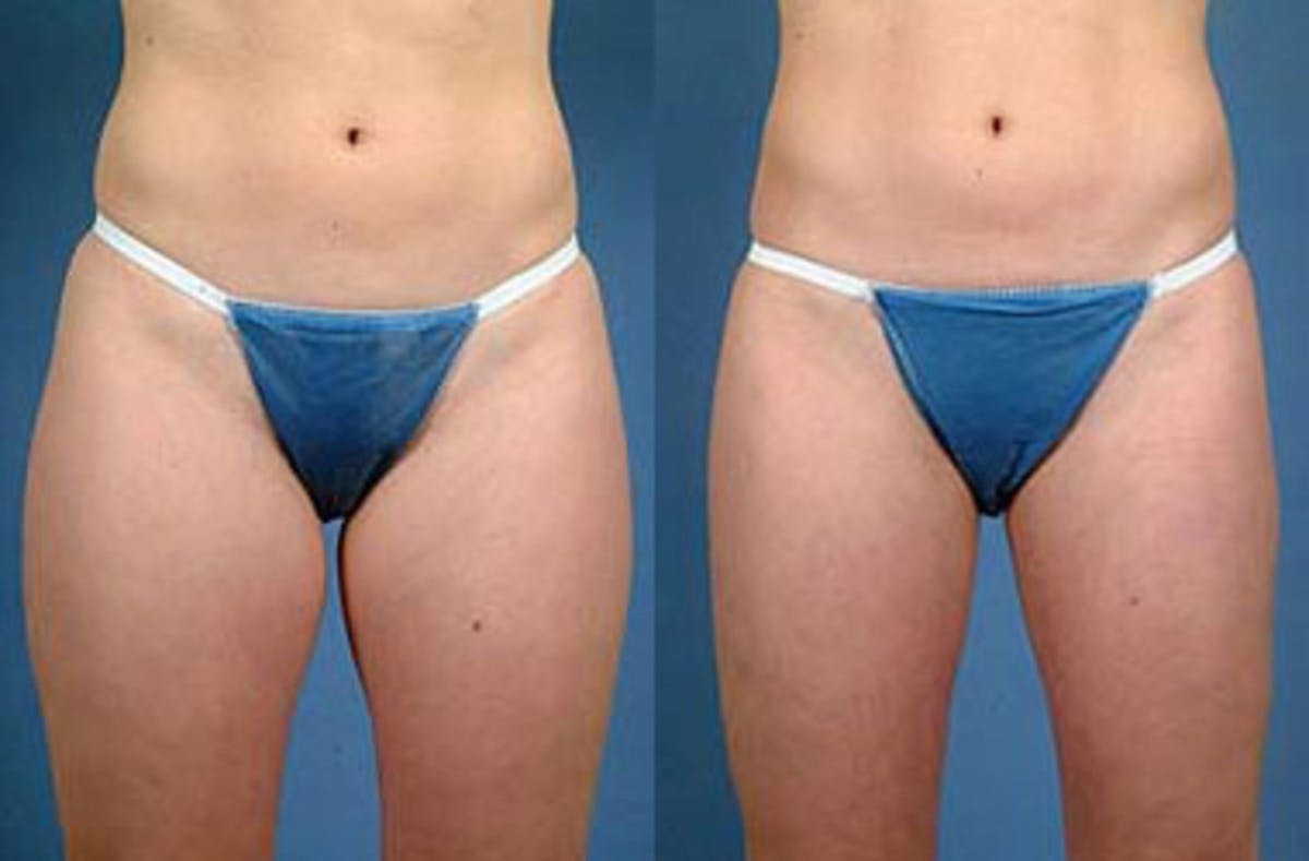 Liposuction for Women Before & After Gallery - Patient 331463 - Image 1