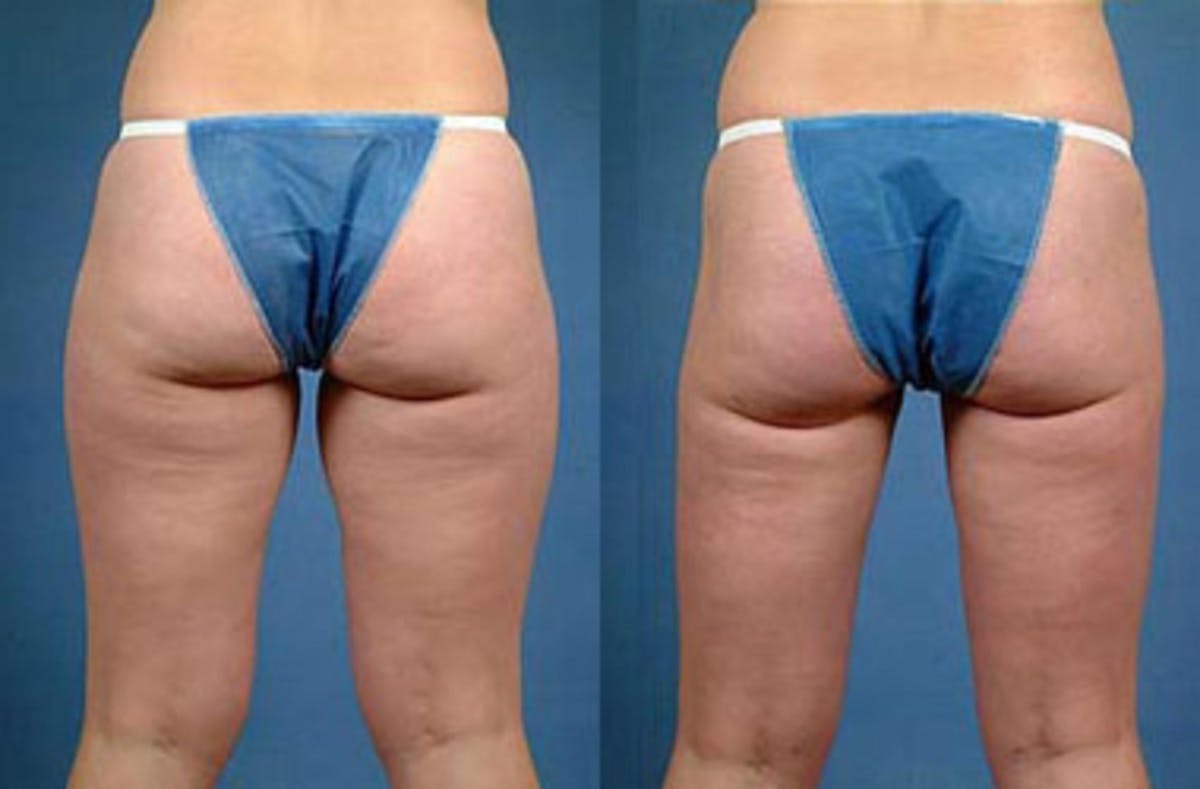 Liposuction for Women Before & After Gallery - Patient 331463 - Image 2