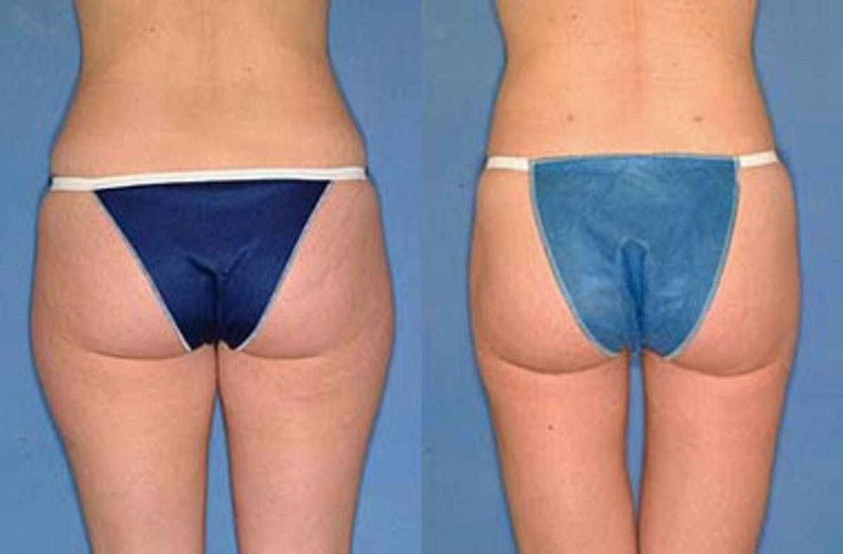 Liposuction for Women Before & After Gallery - Patient 359347 - Image 2