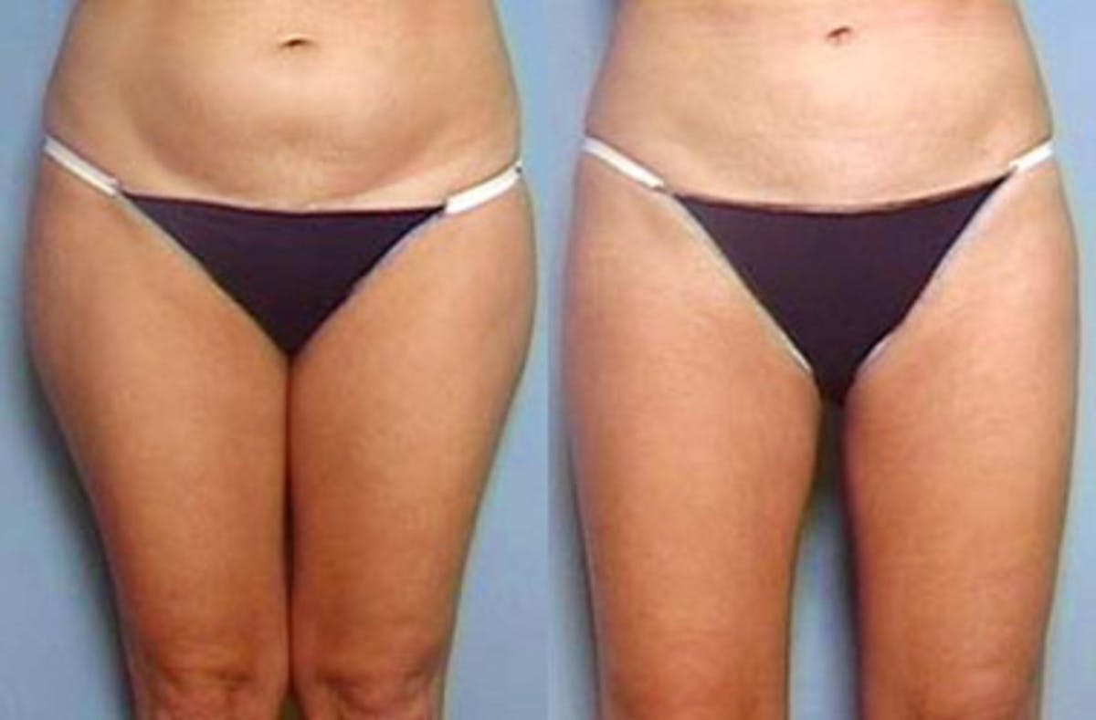 Liposuction for Women Before & After Gallery - Patient 289419 - Image 1