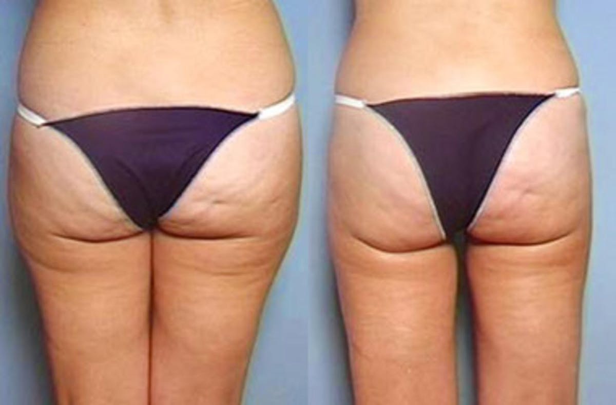 Liposuction for Women Before & After Gallery - Patient 289419 - Image 2
