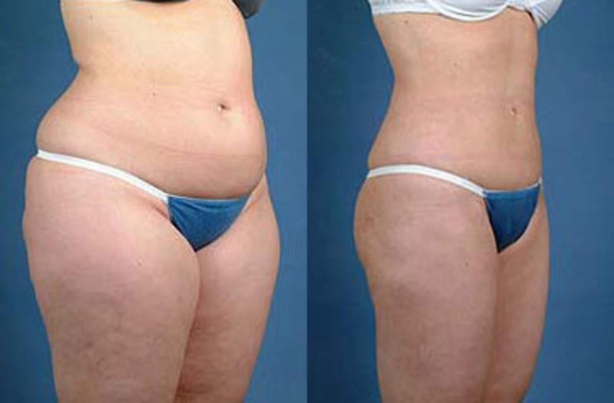 Liposuction for Women Before & After Gallery - Patient 415369 - Image 2