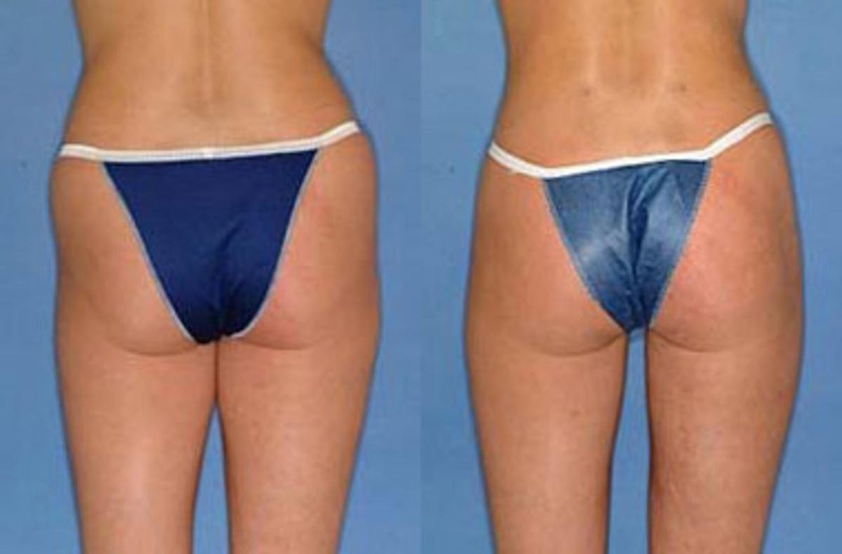 Liposuction for Women Before & After Gallery - Patient 209747 - Image 2