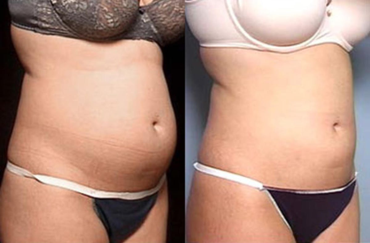 Liposuction for Women Before & After Gallery - Patient 285694 - Image 1