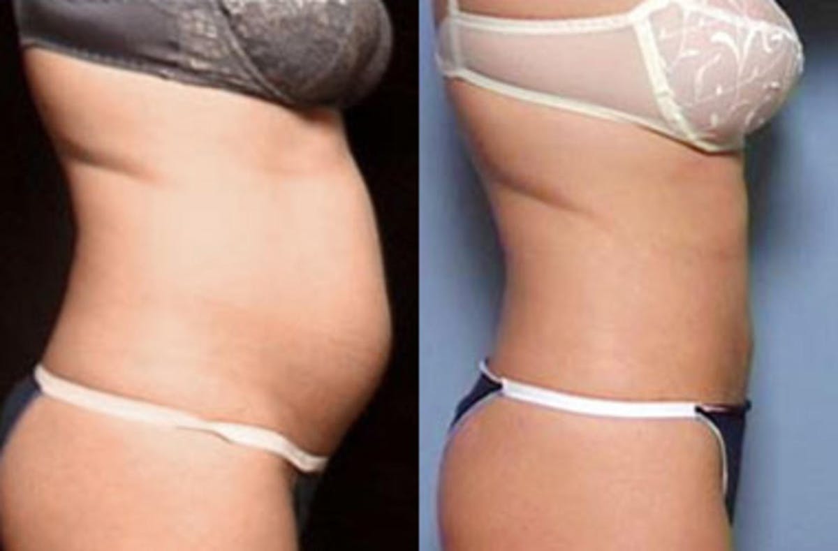 Liposuction for Women Before & After Gallery - Patient 285694 - Image 2